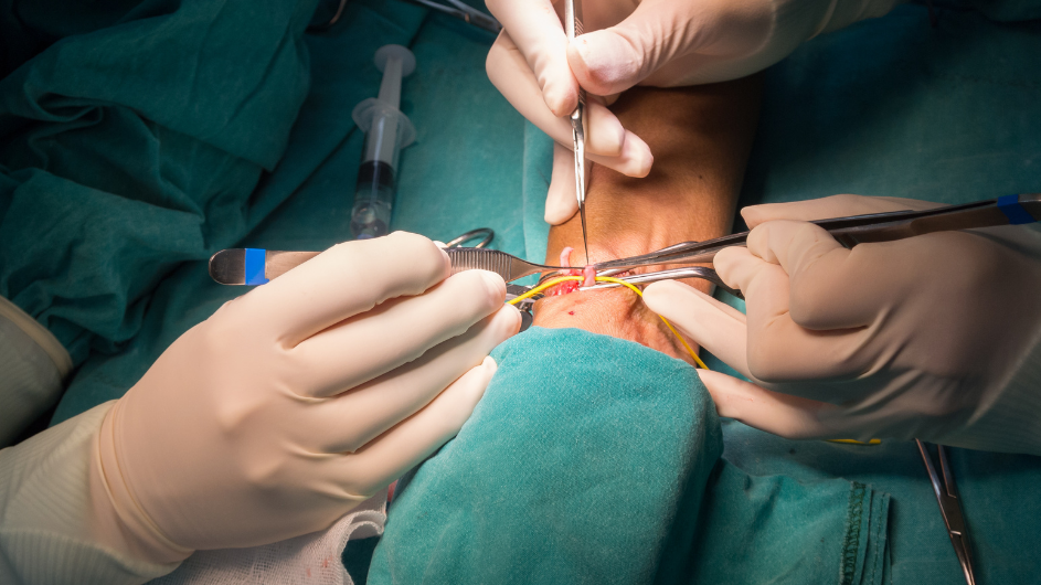 Arterio-venous fistula
